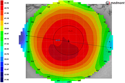 corneal Topography